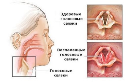 Ларингіт симптоми, методи діагностики і лікування гострого і хронічного ларингіту