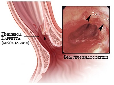 Tratamentul herniei esofagului prin metode și operații tradiționale
