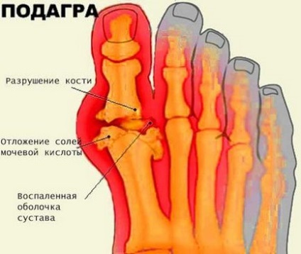 Tratamentul gutei - medicamente care elimină acidul uric