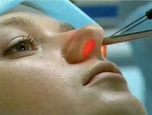 Лікування поліпів в носі без операції, народні методи