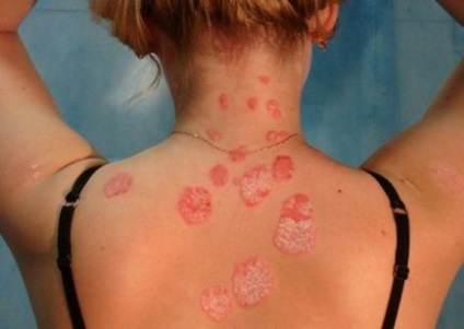Psoriasis otthoni kezelési - ricinusolaj - A Guide to bőrbetegségek