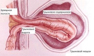 Tratamentul remediilor herniei ombilicale - frumos la modă