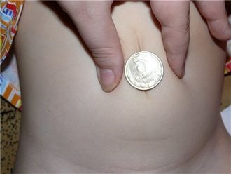 Kezelése köldöksérv népi orvosság - szép divatos (sérv) Kezelése köldöksérv népi orvosság - gyönyörű divat