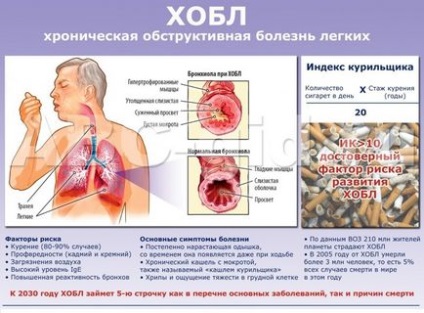 Tratamentul bolnavilor și bronșitei obstructive - Centrul Medical Saratov-Dance