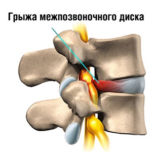 Hernia intervertebrală