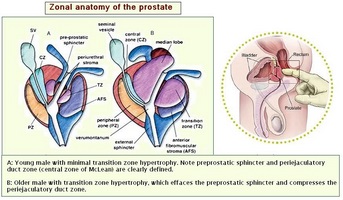 Este posibil să se vindece prostatita în formă cronică