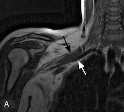 MRI A plexus brachialis, karfonat képalkotó Moszkvában