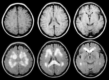 Domnul cu boala Parkinson, tomografie în diagnosticul bolii Parkinson