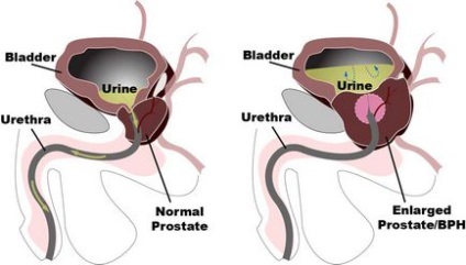 Etapa inițială a adenomului de prostată este tratamentul adenomului prostatic de 1 grad