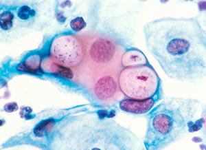 Наявність антитіл iga, igg, igm до бактерії chlamydia pneumoniae - інтерпретація результатів