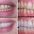 Нарощування зубів вартість самого незатратним способу відреставрувати зуби