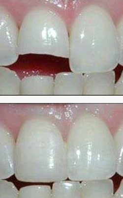 Нарощування зубів вартість самого незатратним способу відреставрувати зуби