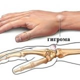 Metode tradiționale de tratare a higromului