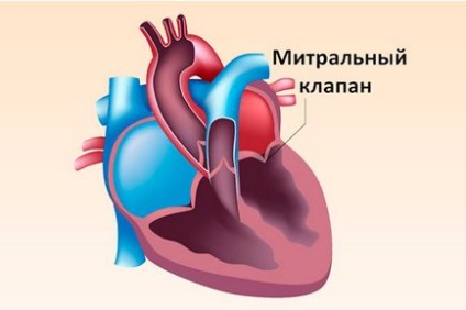 Insuficiența valvei mitrale, gradul de boală, tratamentul și prognosticul