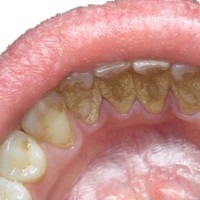 Нікотин впливає на здоров'я зубів