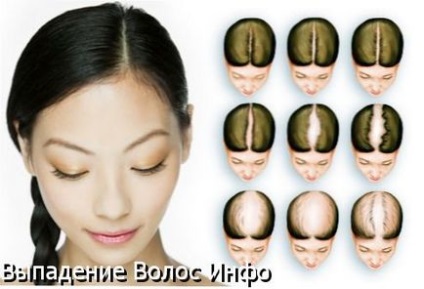 Alopecia la femei