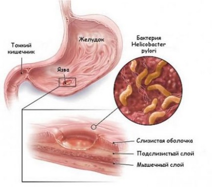 Exacerbarea simptomelor ulcerelor gastrice, tratamentul, dieta