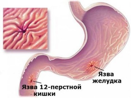 Exacerbarea simptomelor ulcerelor gastrice, tratamentul, dieta