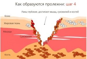 Dezvoltarea ulcerului și a ulcerului sub presiune reprezintă etapa de dezvoltare, îngrijire și recuperare