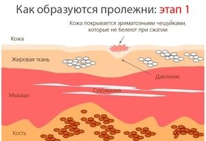 Освіта пролежнів і виразок - стадії розвитку, догляд і відновлення