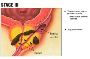 Caracteristicile tantalului medicamentos în prostatită