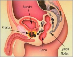 Caracteristicile tantalului medicamentos în prostatită