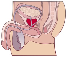 Caracteristicile tantalului medicamentos în prostatită