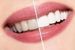 Відбілювання зубів міфи і правда