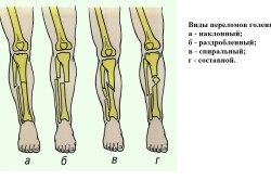 Перелом гомілки види і лікування