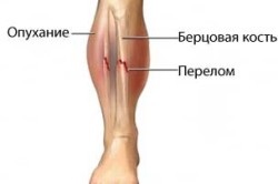 Fractura tipurilor de picior inferior și tratamentul