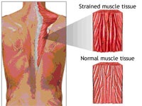 De ce muschii de dureri de spate de-a lungul coloanei vertebrale a cauzei, tratamentul durerii musculare