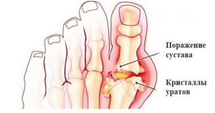 Подагра лікування медикаментами і народними засобами