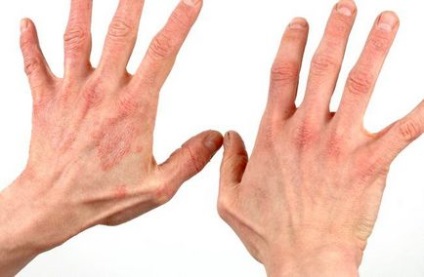 Почервоніння між пальцями рук