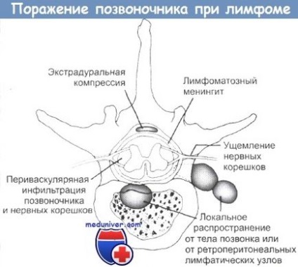 Központi idegrendszeri lymphoma - klinikán kezelés