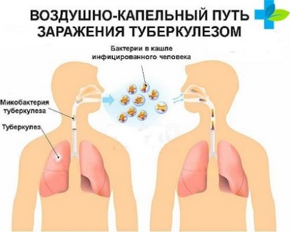 Причини туберкульозу легенів