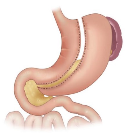 A hosszirányú gastrectomián PHM, mosogató üteme fogyás, táplálkozás, felügyelet, bariatric