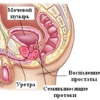 Prostatita - simptome și tratament cu remedii folclorice la domiciliu