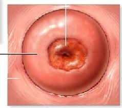 Радіочастотна абляція ерозії шийки матки