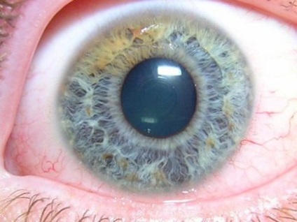Iris al ochiului ce este, boli, funcții, structură