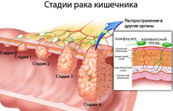 Simptomele cancerului intestinal, clasificarea, etapele, tratamentul cancerului intestinal și prevenirea