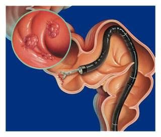 Simptomele cancerului intestinal, clasificarea, etapele, tratamentul cancerului intestinal și prevenirea