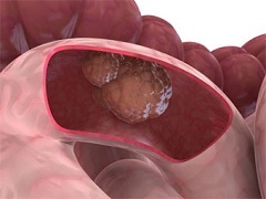 Cancerul intestinului - simptome, etape, tratament