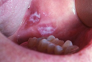 Simptomele cancerului oral, tratamentul și prevenirea cancerului