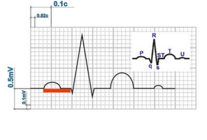 Decodarea intervalului eq pq - timpul de trecere a excitației la atriu la miocardul ventricular