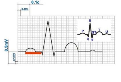 Розшифровка ЕКГ інтервал pq - час проходження збудження по передсердям до міокарда шлуночків
