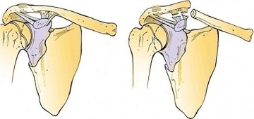 Реабілітація після перелому лопатки