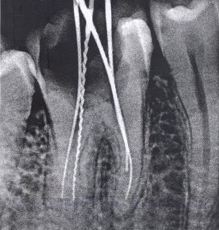X-ray a maxilarului unui copil și a unui adult cum și când este făcut