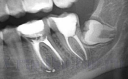 X-ray a maxilarului unui copil și a unui adult cum și când este făcut