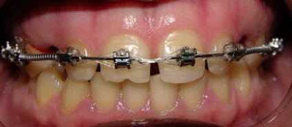 Crăpături între dinți