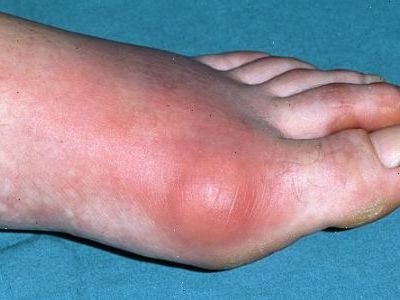 Conuri pe picioare, cauze și tratament posibil